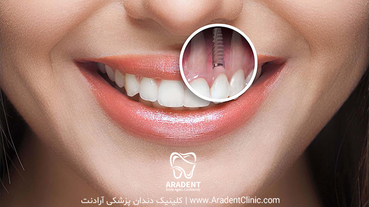مراقبتهای قبل و بعد از ایمپلنت 002