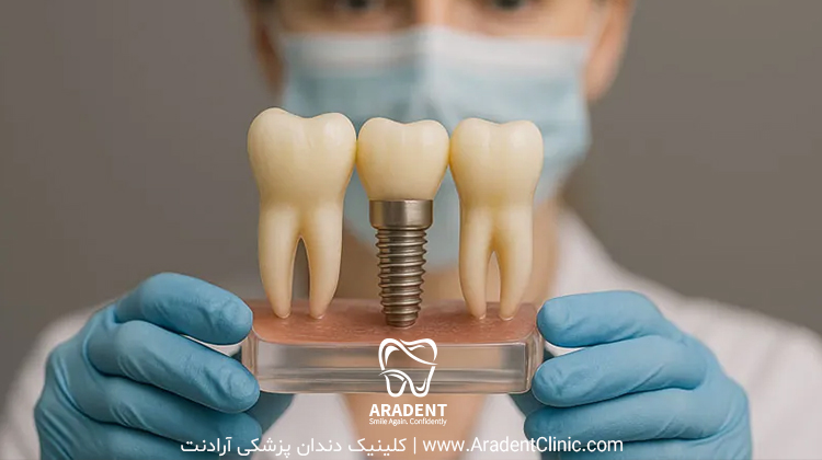 طول عمر ایمپلنت چقدر است و به چه عواملی بستگی دارد؟ 003