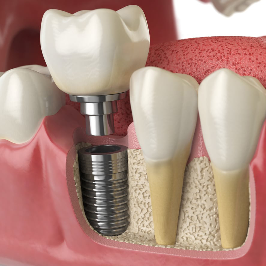dental implants 1