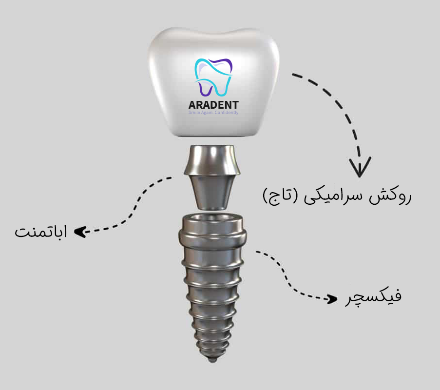 implant materials elastration